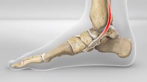 Knick Senkfuss Knick Plattfuss Schwache Der Tibialis Posterior Sehne Gelenk Klinik De