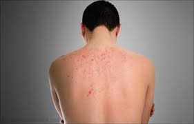 Image result for flea bites