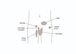 Groin pain is generally the result of muscle, tendon, and ligament strain in sports. Groin Pain Syndrome Zamst