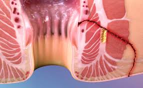 Image result for anal fistula