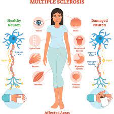 In multiple sclerosis (ms), the immune system attacks and destroys the fatty myelin coating that surrounds and insulates nerve cells in a process known as demyelination. Multiple Sclerosis Honorhealth