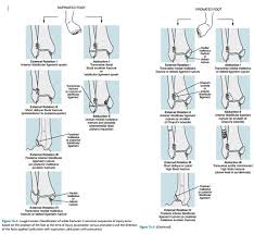 Learn vocabulary, terms and more with flashcards, games and fracture is a spiral fracture of the proximal third of the fibula associated with a tear of the distal. Ankle Fractures Lauge Hansen Classification Diagram Quizlet