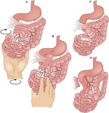 Image result for Intestinal Malrotation