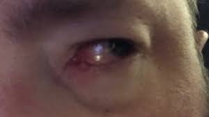 Klumpen kan se ut som en byll eller kvise, og den kan være fylt. Bunnytrash Oyevirus