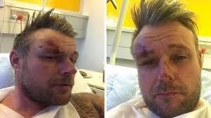 Ronni Garner kørt ned af varevogn: Det sagde 'smak' og jeg gik ud som et  lys