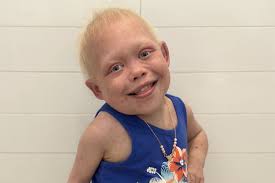 TikTok's Bella Brave Dies at 10, Mom Shares in Heartbreaking Update