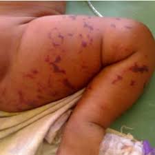 Neonatal purpura fulminans, protein c. Clinical Photographs Showing Regressing Lesions Download Scientific Diagram