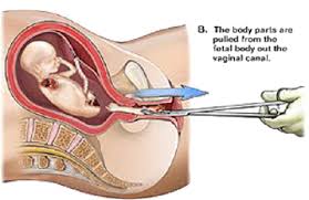 2nd Trimester
