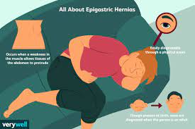 Epigastric Hernia: Symptoms, Diagnosis, And Treatment