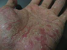 Dyshidrosis Wikipedia