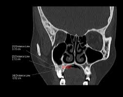 Image result for Maxillary Sinus