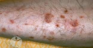 Image result for Pigment stains on the shin