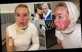 Abbie quinnen says she will be with aj pritchard forever and ever. Abbie Quinnen Reveals The Horrific Burns She Sustained In Accident Wstale Com