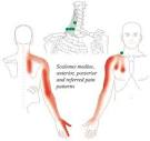 How to truly identify and treat thoracic outlet syndrome (TOS ...