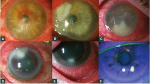 The two bacteria most commonly responsible for this type of infection in the u.s. Racgp Management Of Microbial Keratitis In General Practice