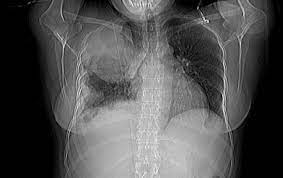 It is an essential part of the mesothelioma diagnosis and treatment process. Malignant Pleural Mesothelioma Tnm Staging Radiology Reference Article Radiopaedia Org