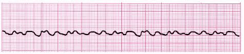 Acls Ecg Rhythm Strips Pretest Question Answers Quiz Pdf