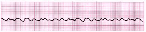 For that we provide acls test answers 2021 real test. Acls Ecg Rhythm Strips Pretest Question Answers Quiz Pdf