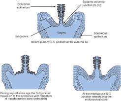 During adolescence the physiological transformation zone of the cervix in the virgin undergoes limited change when compared to that of girls who are sexually promiscuous; 24 Cervical Screening Test Nurse Key