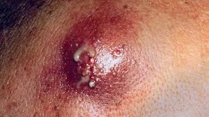 Sometimes, dead skin can clog up a hair follicle and sometimes cutting a naturally curly. Buttocks Breakouts How To Get Rid Of The Bumps On Your Behind Everyday Health