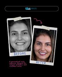 Meet Mary Tabone, who travelled to Dent Ally India for a complete Smile  Makeover and left with a brighter, more confident, and naturally beautiful  smile! Her smile transformation was crafted with: ✓