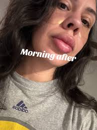 Hyaluronic Acid Lip Results