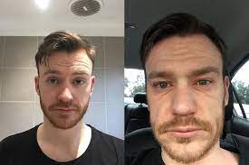 My 23 Year Old Face Before And After An Allergic Reaction Pics