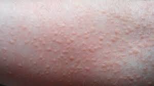 Therefore, before adding any food to your diet. Skin Disorders Pictures Causes Symptoms Treatments And Prevention