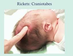 Image result for Craniotabes