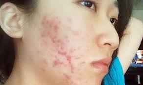 Karena yoghurt mengandung zat probiotik, protein, vitamin c, dan sejumlah vitamin lainnya yang baik untuk kulit. Cara Menghilangkan Jerawat Membandel Guisantes
