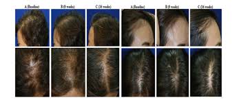 10 badran kw, sand jp. Hope For Baldness Cure As Stem Cells Trigger Hair Growth In Weeks