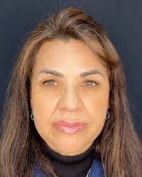 O Poder da Toxina Botulínica com Preenchimento Labial, Podemos ver que com  a utilização dessas duas técnicas, houve uma grande melhora na qualidade da  pele e na estrutura labial, trazendo uma ...