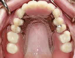 We did not find results for: Removable Partial Denture For Maxillary Incisors Spear Education