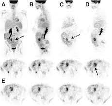 18f Fdg Pet In Pregnancy And Fetal Radiation Dose Estimates Journal Of Nuclear Medicine