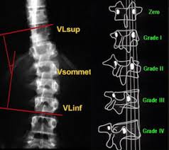 Radiographie d'une scoliose à convexité lombaire droite. Un Medecin Du Sport Vous Informe Scolioses Structurales Idiopathiques De L Enfant