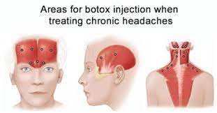 Check spelling or type a new query. Botox Treatment For Headaches Best Botox Injection Specialist In Brooklyn