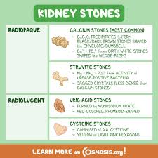 Image result for Calcium Nephrolithiasis