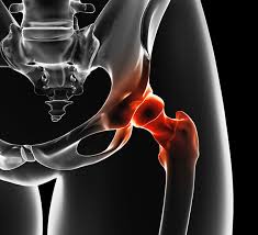 Behandeling van heuppijn: oorzaken, symptomen, behandeling en zelfdiagnostiek