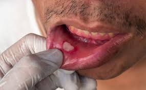 Image result for Canker sores symptoms roof of the mouth