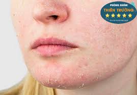 Da khô quanh miệng và cách khắc phục - Da liễu Thiên Trường