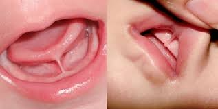 Severe tongue ties are called anterior tongue ties. Lip And Tongue Ties In Babies Pediatric Dental Associates Of Randolph