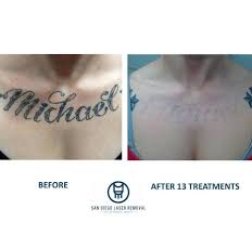 We are the only clinic in san diego that offers per treatment pricing as well as flat rate complete removal packages (unlimited treatments until your tattoo is completely gone) guaranteed. Facebook
