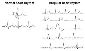 Also known as coronary artery disease, is a symptom of irregular heartbeat, because in: Safebeat Initiative Did Your Heart Skip A Beat All About Arrhythmias