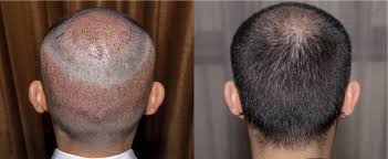 زراعة الشعر قبل وبعد المميزات والنصائح وأكثر تجميلي