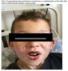 N engl j med 1995; Stevens Johnson Syndrome Induced By Combination Of Lamotrigine And Valproic Acid In A 9 Year Old Boy Irish Medical Journal