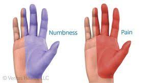 Carpal Tunnel Syndrome Vs Cervical Radiculopathy Carpal Tunnel Syndrome Radiculopathy Carpal Tunnel Relief