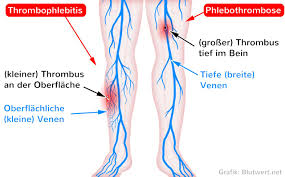Thrombosen sind gefährliche verstopfungen von blutgefäßen. Thrombose Risiko Durch Blutgerinnsel Bildung