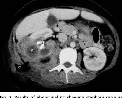 Image result for Perinephric Abscess