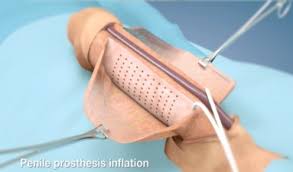 Image result for Penile Prosthesis
