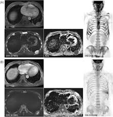 Multiple myeloma (mm) is a debilitating malignancy that is part of a spectrum of diseases ranging from monoclonal gammopathy of unknown significance (mgus) to plasma cell leukemia. Role Of Whole Body Mri For Treatment Response Assessment In Multiple Myeloma Comparison Between Clinical Response And Imaging Response Cancer Imaging Full Text